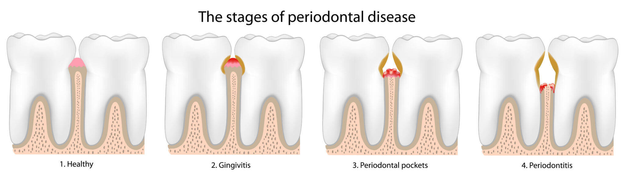 The stages of periodontal disease